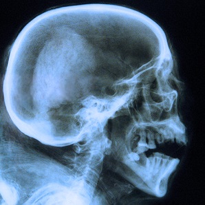 Telerradiografía de Cráneo en Madrid  Radiología Dental Majadahonda  al precio de 29€