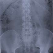 Radiografía de columna