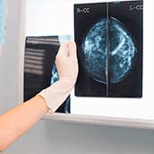 Mamografía bilateral en Sabadell